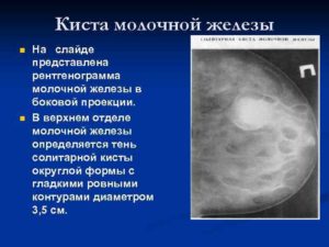 Может ли киста молочной железы перерасти в рак