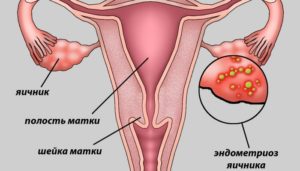 Спринцевание при эндометриозе матки
