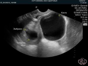 Киста яичника при беременности на ранних сроках