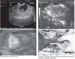 Киста яичника при беременности на ранних сроках