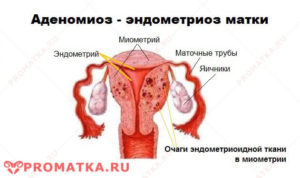 Диффузный эндометриоз матки
