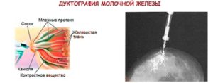 Дуктография молочной железы что это такое