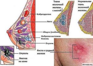 Киста левой молочной железы
