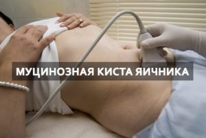 Муцинозная киста яичника прогноз