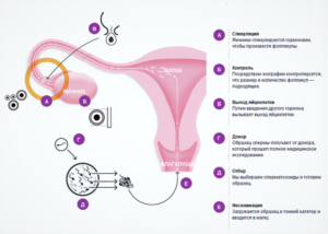 Гормональная стимуляция яичников