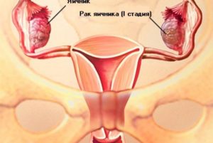 Опухоли матки и яичников симптомы