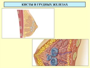 Болит киста в молочной железе