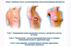 Реконструкция молочной железы