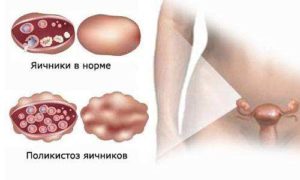 Фолиевая кислота при поликистозе яичников