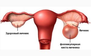 Фолликулярная киста яичника и беременность