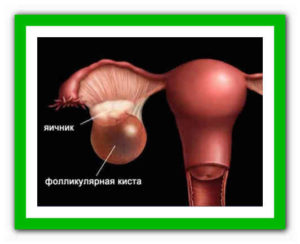 Фолликулярная киста яичника и беременность