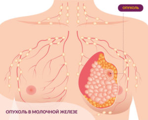 Проточный рак молочной железы
