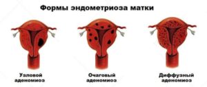 Эндометриоз внутренний диффузная форма