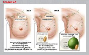 Как определить рак молочной железы