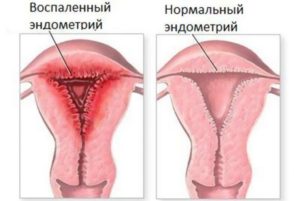 Эндометриоз шейки матки симптомы и лечение