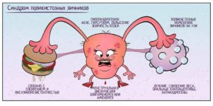 Метформин при поликистозе яичников