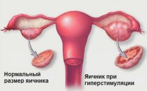 Беременность и гиперстимуляция яичников