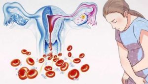 Как остановить маточное кровотечение при климаксе