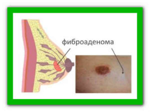 Может ли фиброаденома молочной железы перерасти в рак