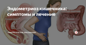 Эндометриоз толстой кишки симптомы