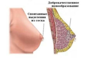 Прозрачная жидкость из молочных желез
