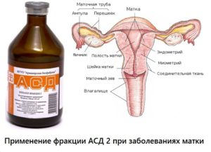 Лечение миомы матки фракцией асд 2