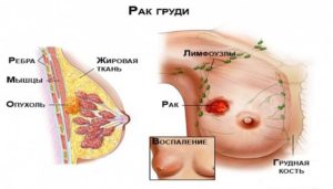 Нащупала шарик в молочной железе