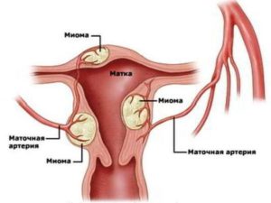 Чистотел при миоме матки