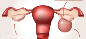 Киста на яичнике лечение и от чего она появилась у женщин