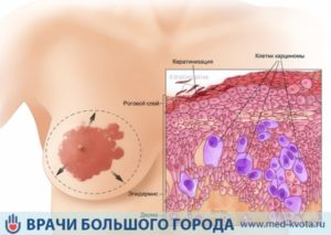 Педжета болезнь молочной железы