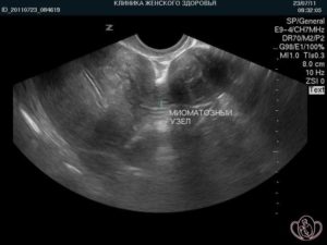 Миома матки с центрипетальным ростом узла что это такое