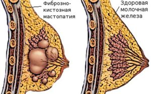 Уплотнение в молочной железе лечение народными средствами