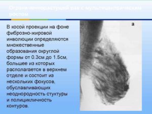 Фиброзно жировая инволюция молочных желез что это