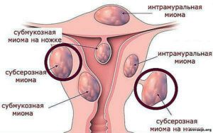 Интрамуральная миома матки