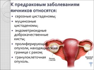 Болезни яичников у женщин перечень