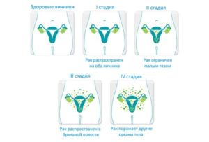Признаки рака яичника на ранней стадии у женщин