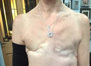 Удаление молочных желез у женщин