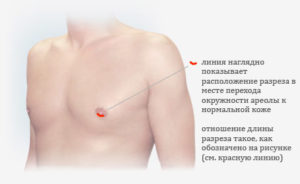 Уплотнение в молочной железе у мужчины