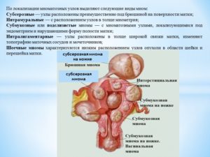 Чем отличается фибромиома матки от миомы