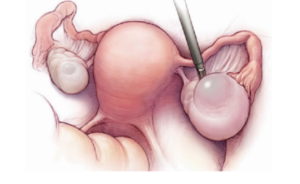 Разрыв кисты яичника последствия