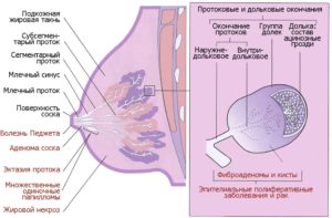 Дуктэктазия молочной железы лечение