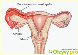 Воспаление маточных труб и яичников