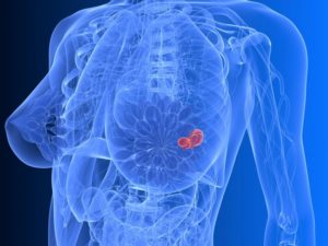 Онкология рак молочной железы