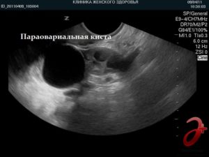 Ретенционное образование правого яичника