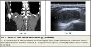 Метастазы в почки при раке молочной железы