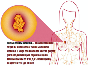 Психосоматика рака молочной железы