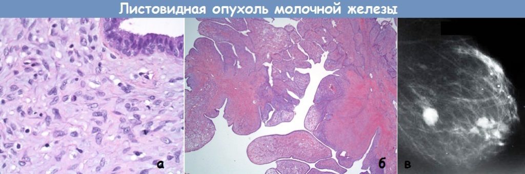 Листовидная опухоль молочной железы