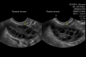Сколько фолликулов должно быть в яичнике при эко