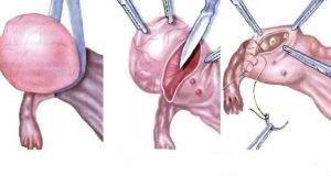 На какой день выписывают после лапароскопии кисты яичника