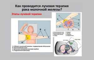 Осложнения после лучевой терапии молочной железы